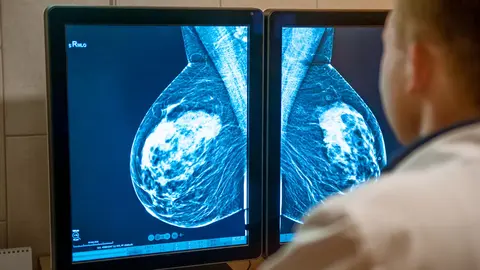 La inteligencia artificial podr&iacute;a ser una gran herramienta en la lucha contra el c&aacute;ncer de mama